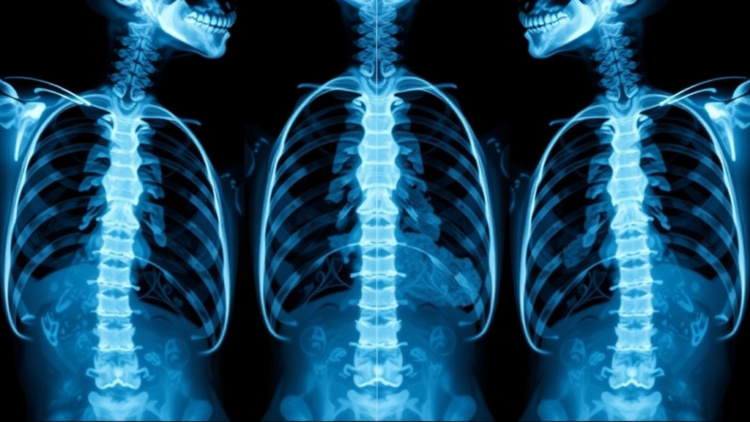 One Sentence in a Radiology Report Tripled Osteoporosis Care After Fractures