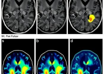 Symptomatic, Incidental DWI Lesions Show Distinct Risk Factors in Cerebral Amyloid Angiopathy