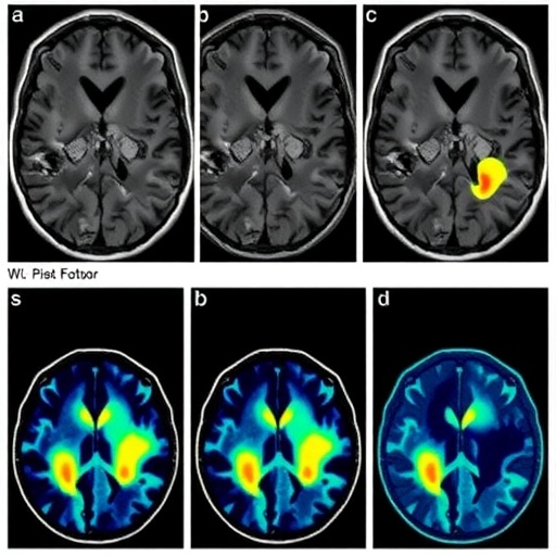 Symptomatic, Incidental DWI Lesions Show Distinct Risk Factors in Cerebral Amyloid Angiopathy