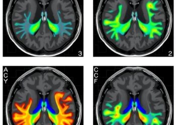 Territory-specific CT perfusion tracks blood flow changes after chronic MCA revascularization