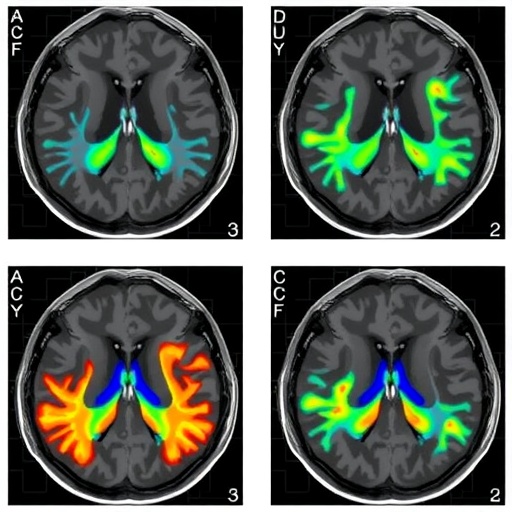 Territory-specific CT perfusion tracks blood flow changes after chronic MCA revascularization