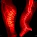 Treating Paradoxical Deep Vein Thrombosis in Congenital Afibrinogenemia