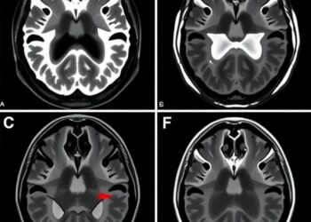 Vasospasm and Delayed Ischemia After Aneurysmal Rupture With Hemorrhage