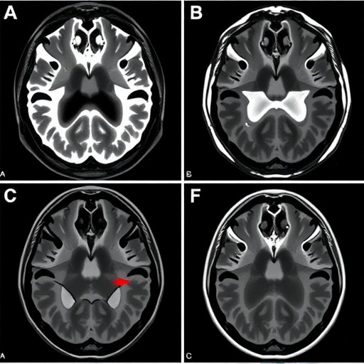 Vasospasm and Delayed Ischemia After Aneurysmal Rupture With Hemorrhage