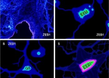 ZEB1 Drives Epithelial-Mesenchymal Transition and Hormone Resistance in Endometriosis