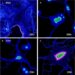 ZEB1 Drives Epithelial-Mesenchymal Transition and Hormone Resistance in Endometriosis