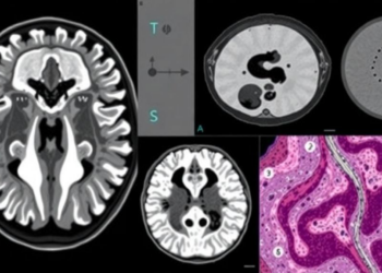 AI Combines MRI Scans and Tissue Slides to Predict Chemotherapy Response in Nasopharyngeal Cancer
