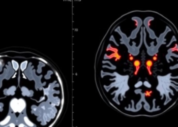 PET/MR Scan Predicts Prostate Cancer Relapse Before Surgery