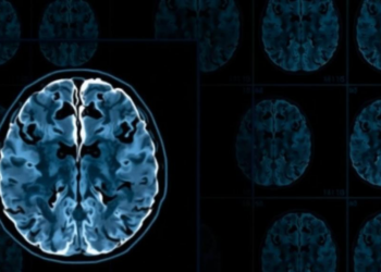 AI Spots the Earliest Whisper of Alzheimer’s Disease in Routine Brain Scans