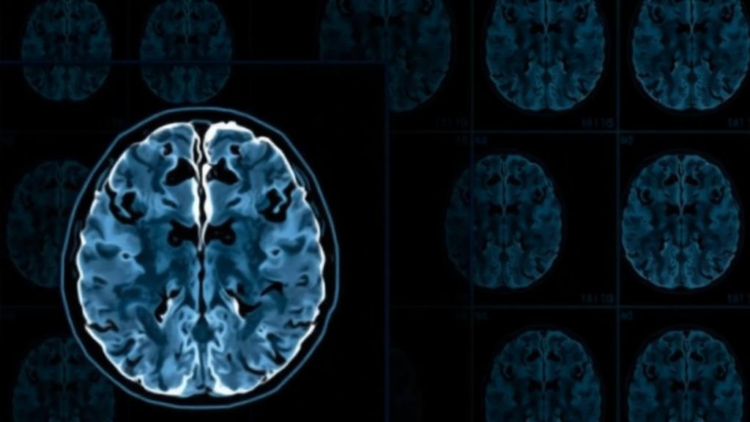 AI Spots the Earliest Whisper of Alzheimer’s Disease in Routine Brain Scans