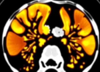 AI Reads CT Scans to Predict Esophageal Cancer Response, With Mixed Results