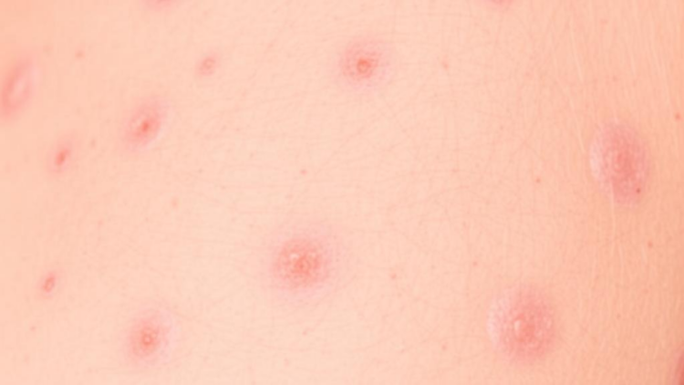 Who Counts? Single-Center Audit Probes Whether a National Psoriasis Registry Truly Reflects Real Patients