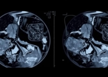 Deep Learning Models Hit 98% Accuracy in Mammogram Breast Cancer Detection