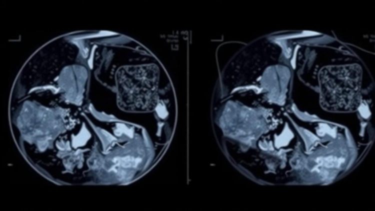 Deep Learning Models Hit 98% Accuracy in Mammogram Breast Cancer Detection