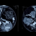 Deep Learning Models Hit 98% Accuracy in Mammogram Breast Cancer Detection