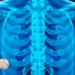 Switching HIV Drugs or Adding Zoledronic Acid Rebuilds Bone Lost to Tenofovir