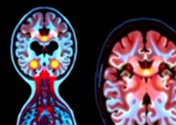 Brain Scans Reveal Hidden Clues to Gut Scarring in Crohn’s Disease