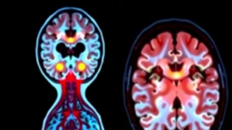 Brain Scans Reveal Hidden Clues to Gut Scarring in Crohn’s Disease