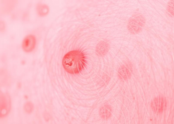 Eczema Drug Dupilumab Shows Promise Against Stubborn IgG4-Related Disease