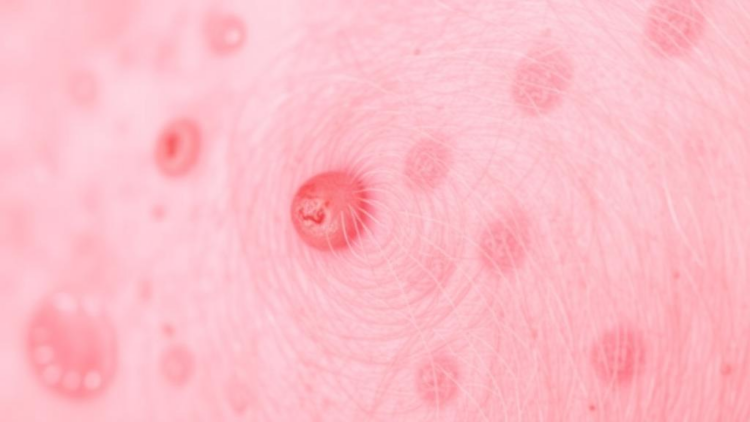 Eczema Drug Dupilumab Shows Promise Against Stubborn IgG4-Related Disease