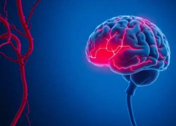 When Lupus Strikes the Brain’s Veins: Rare Childhood Stroke Clue Emerges
