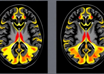 Rare Sarcoma Brain Metastases Show Striking Imaging Signatures on MRI Scans