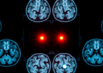 Brain Scans Reveal Which Sleep Disorder Patients Will Develop Dementia