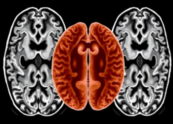 Brain Scans Reveal How Mood Disorder Symptoms Map onto Cortical Structure