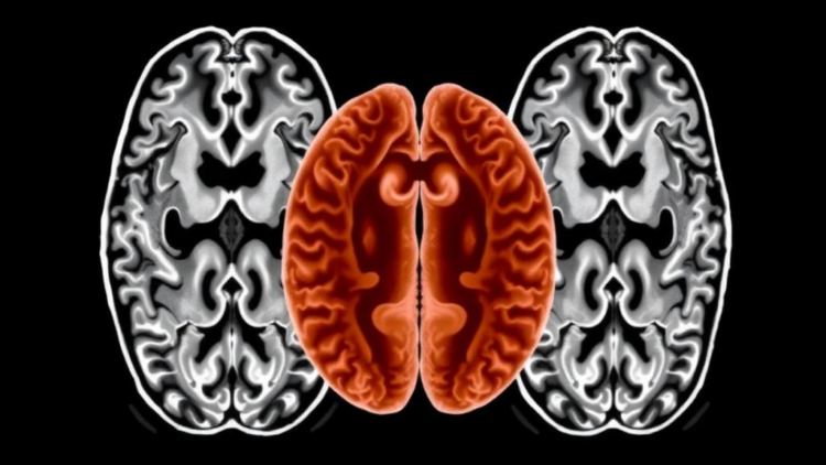 Brain Scans Reveal How Mood Disorder Symptoms Map onto Cortical Structure