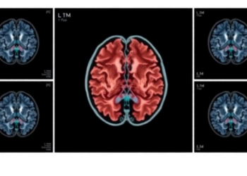 Splitting Radiation Into Multiple Sessions Cuts Recurrence and May Extend Survival After Brain Metastasis Surgery