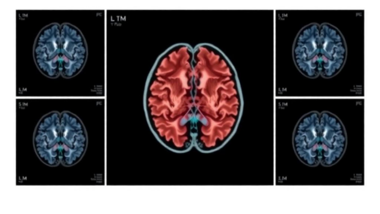 Splitting Radiation Into Multiple Sessions Cuts Recurrence and May Extend Survival After Brain Metastasis Surgery