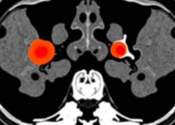 AI Reads Tumor Sub-Regions on Plain CT Scans to Tell Benign from Malignant Sacral Tumors Before Surgery