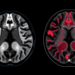 AI Reads MRI Scans to Tell Apart Two Breast Cancer Subtypes Without a Biopsy