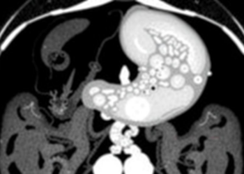 AI Reads Routine CT Scans to Predict Gastric Cancer Biomarker Without Biopsy
