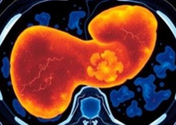 Fatty Pancreas on CT Scans Linked to Age, Body Fat and Duct Changes in New Study