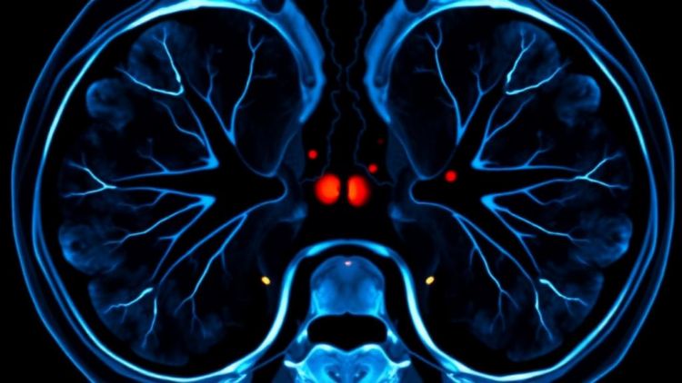 PET Imaging May Spare Patients Risky Drug Withdrawal Before Adrenal Vein Test