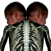 Rare Shoulder Birth Defect Linked to Twin Fractures Once Suspected as Abuse