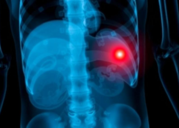 AI Sees What Isn’t There: Chest X-Rays Don’t Reveal Groin Hernias, Study Warns