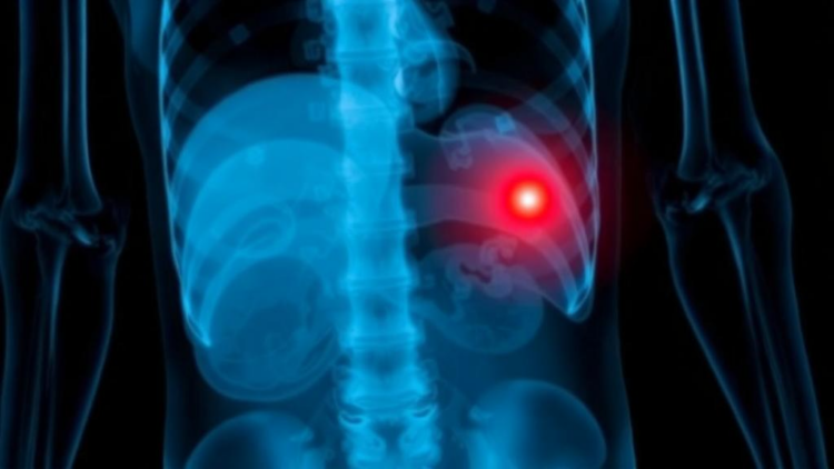 AI Sees What Isn’t There: Chest X-Rays Don’t Reveal Groin Hernias, Study Warns
