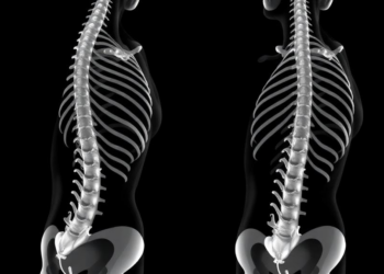 Fake spines, real gains: synthetic CT data teach AI to segment severe scoliosis