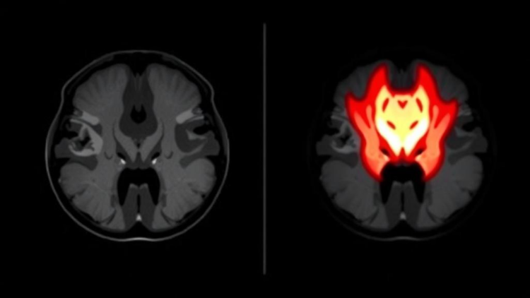 MRI Perfusion Scan Predicts Hip Damage in Babies After Treatment