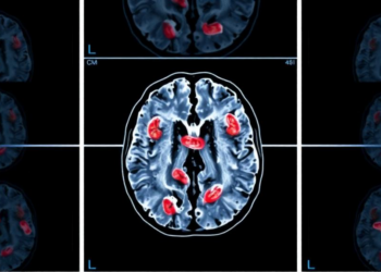 Infections After Radiotherapy May Signal Poorer Survival in Glioblastoma Patients
