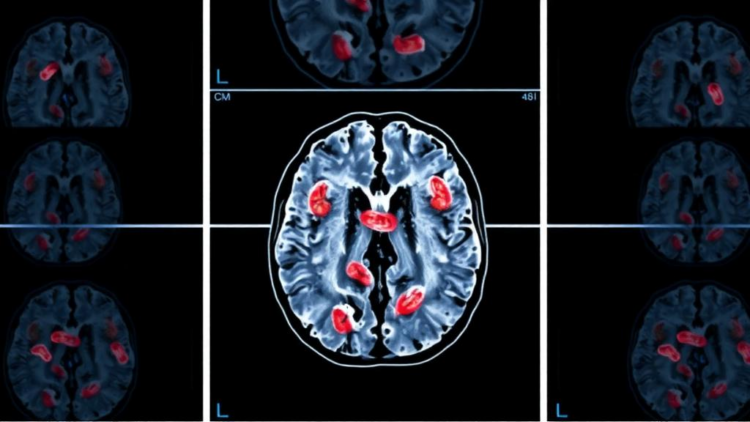 Infections After Radiotherapy May Signal Poorer Survival in Glioblastoma Patients