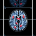 Infections After Radiotherapy May Signal Poorer Survival in Glioblastoma Patients