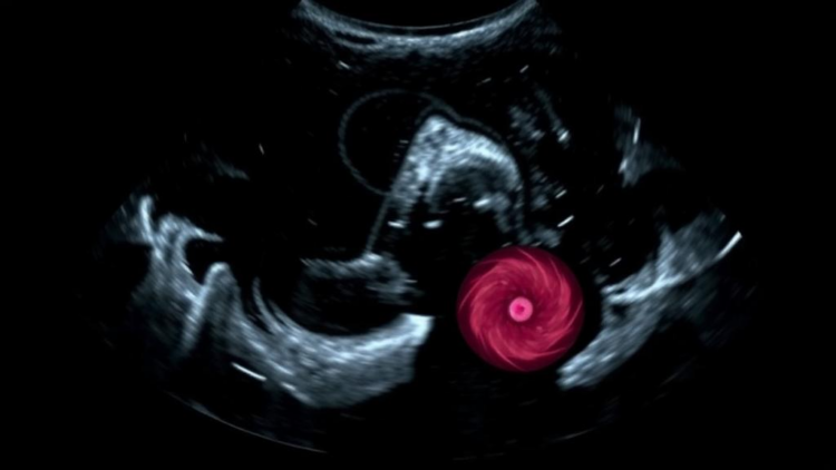 AI Learns to Fake Ultrasound Images to Spot Breast Tumors More Accurately