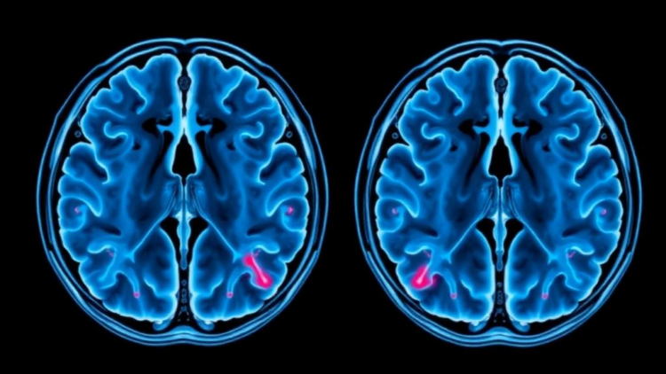 Random-Walk MRI Links Brain Tumour Scans to Microscopic Reality