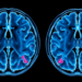 Random-Walk MRI Links Brain Tumour Scans to Microscopic Reality