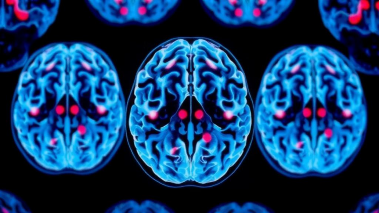 Scientists Find a Vulnerable Window When Brain Metastases Can Still Be Stopped