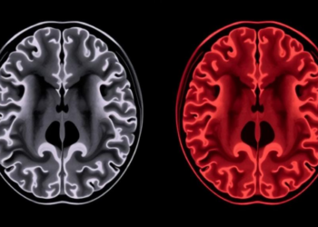 Brain Scan Study Reveals How Gluten Can Attack the Cerebellum in Two Very Different Ways