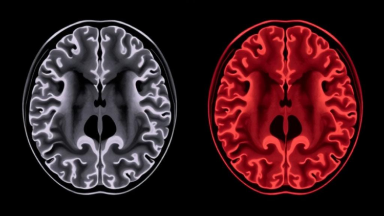 Brain Scan Study Reveals How Gluten Can Attack the Cerebellum in Two Very Different Ways
